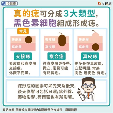 為什麼會長黑痣|痣是什麼？一次了解痣原因、就醫時機以及如何改善